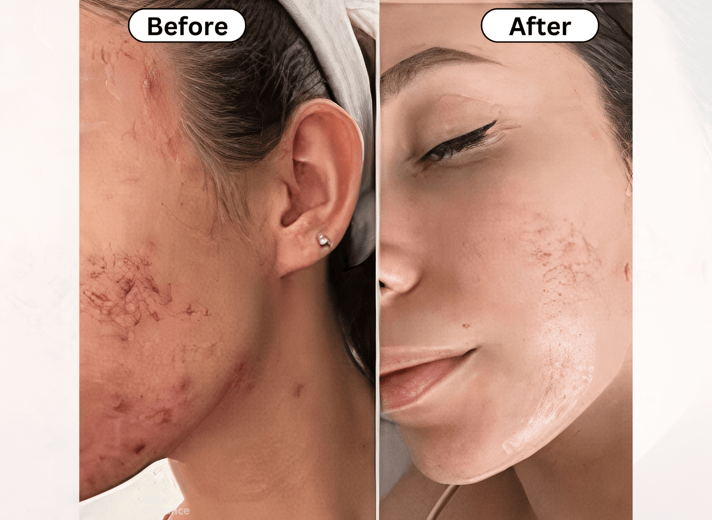 Just Like a Spa Photon Therapy Face Mask™️ - 50% OFF + FREE Gift